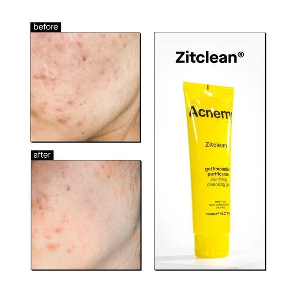 Очищающий гель Acnemy Zitclean Purifying Cleansing Gel 2125 фото