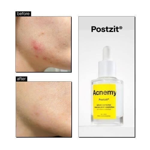 Сыворотка от высыпаний Acnemy Postzit Zit Marks Solution 2127 фото